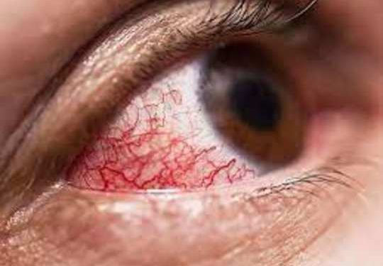 mucormycosis2-540x375